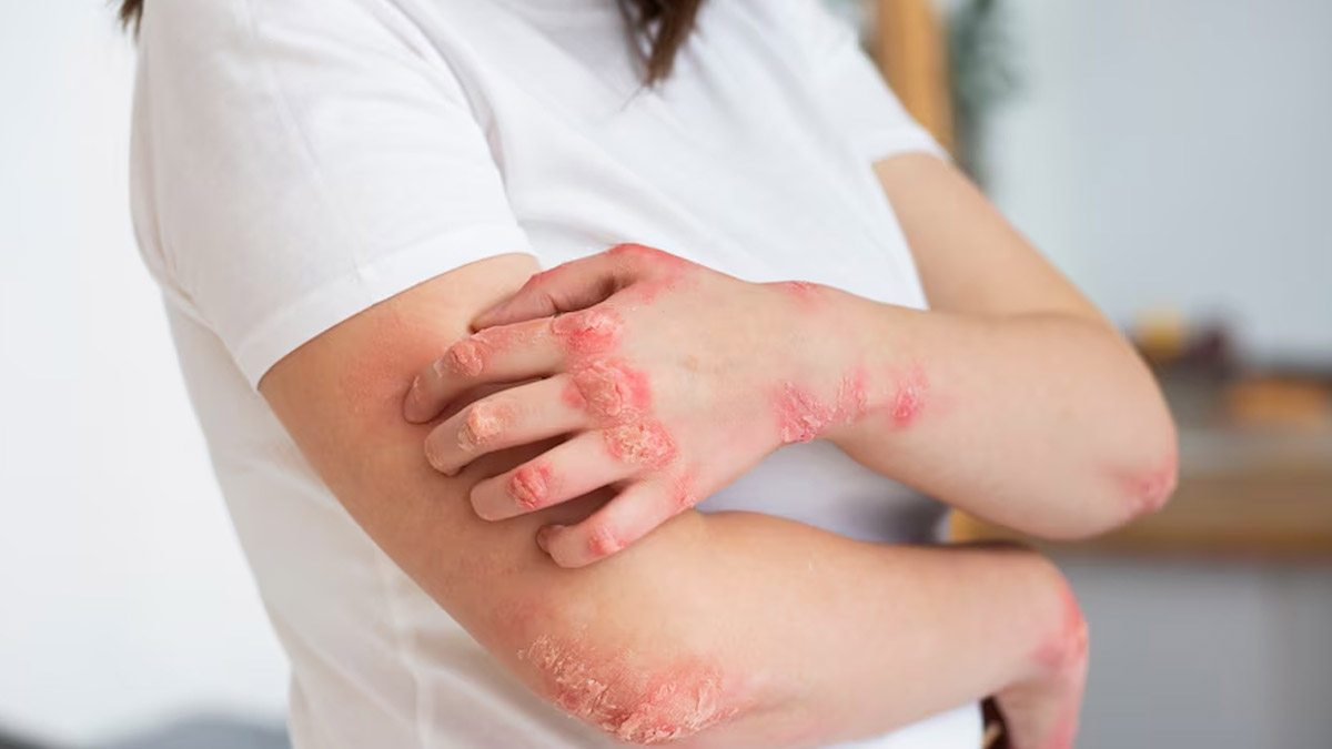 Dermatologist Shares Do's And Don'ts For Psoriasis Management